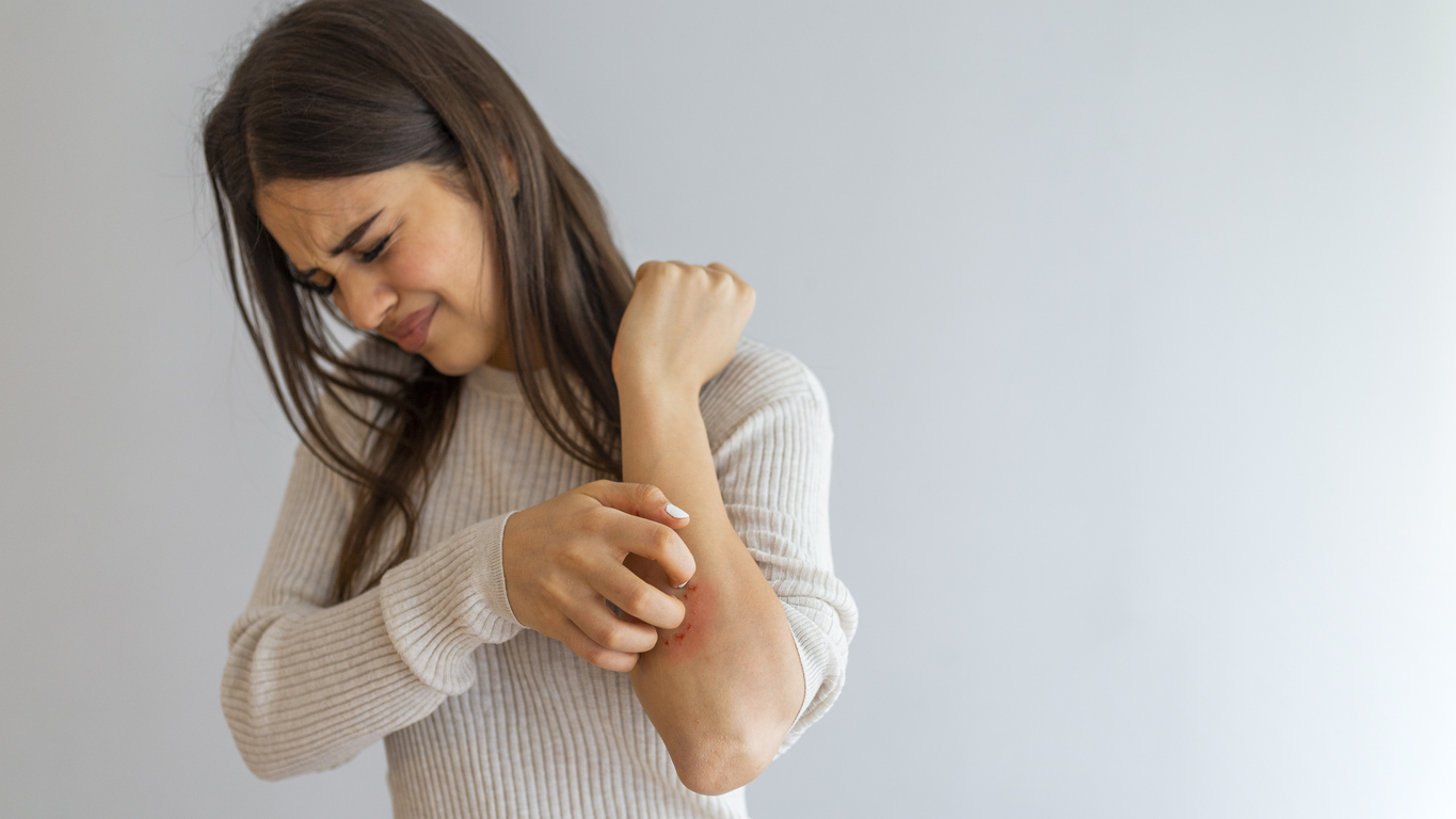 eczema triggers and how to treat