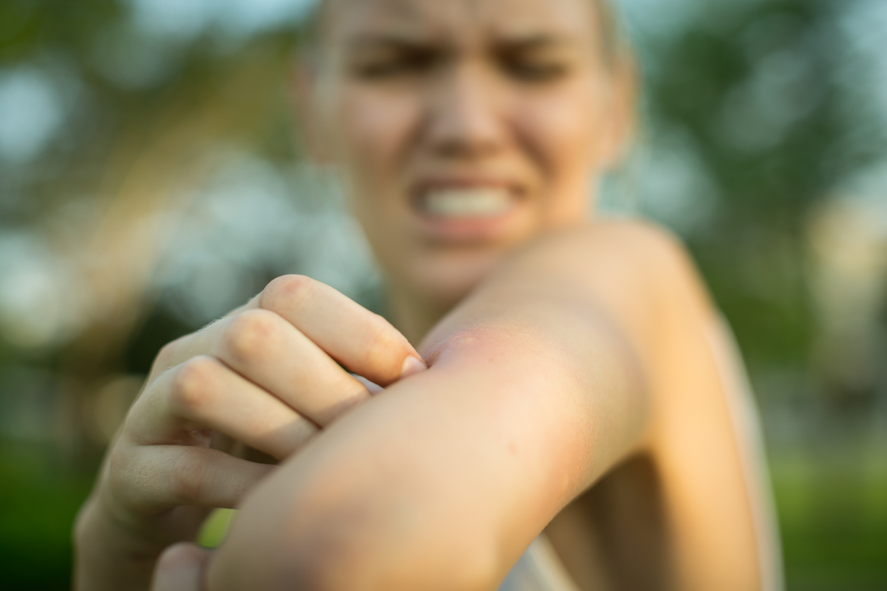 eczema and heat in the summer